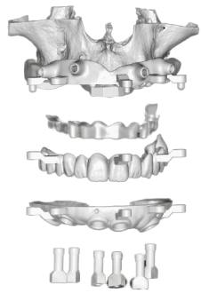 Pianificazione 3D chirurgia guidata: dima, modelli e impianti